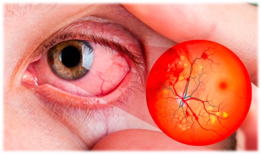 1 Retinopatía inteligencia artificial