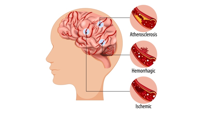 3 Dermatitis atópica accidente cerebrovascular
