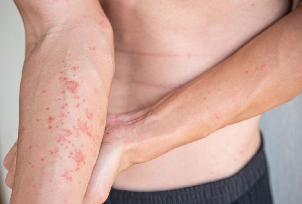 4 Dermatitis atópica accidente cerebrovascular