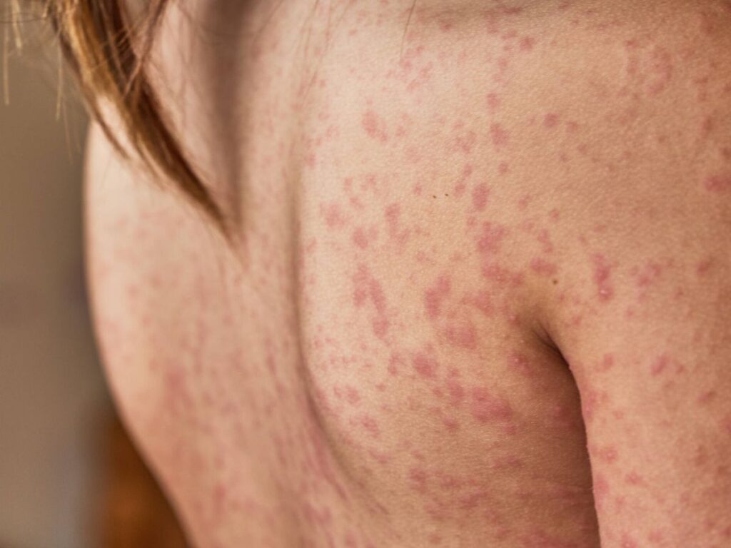 5 Dermatitis atópica accidente cerebrovascular