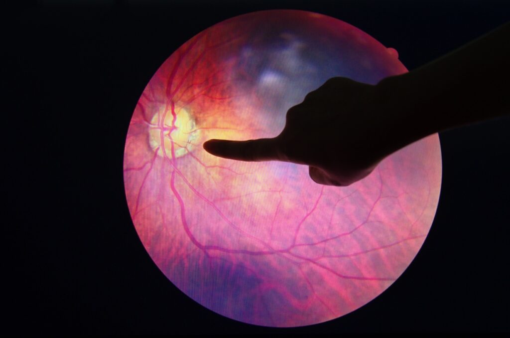 5 Retinopatía inteligencia artificial