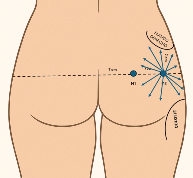 6 acido hialuronico gluteos
