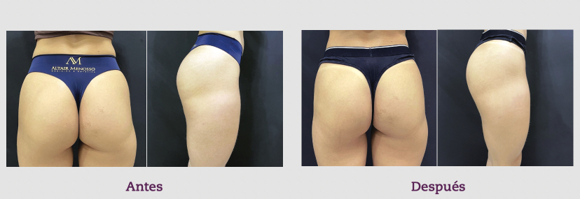 05 acido hialuronico gluteos