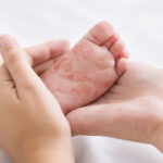 0 Dermatitis atópica infantil