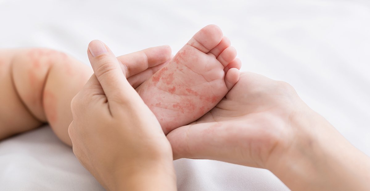 0 Dermatitis atópica infantil