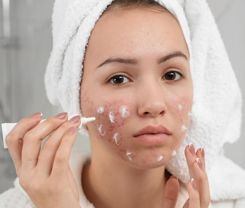 0-Dermocosmeticos-acne-consenso
