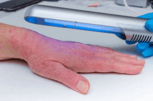 0 Psoriasis fototerapia