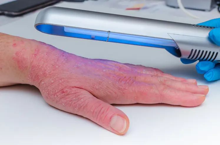 0 Psoriasis fototerapia
