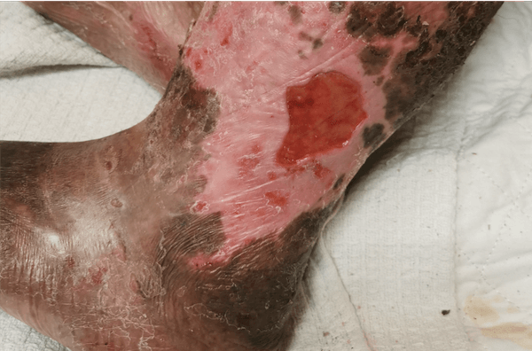 0 Ulceras desbridamiento enzimatico 2