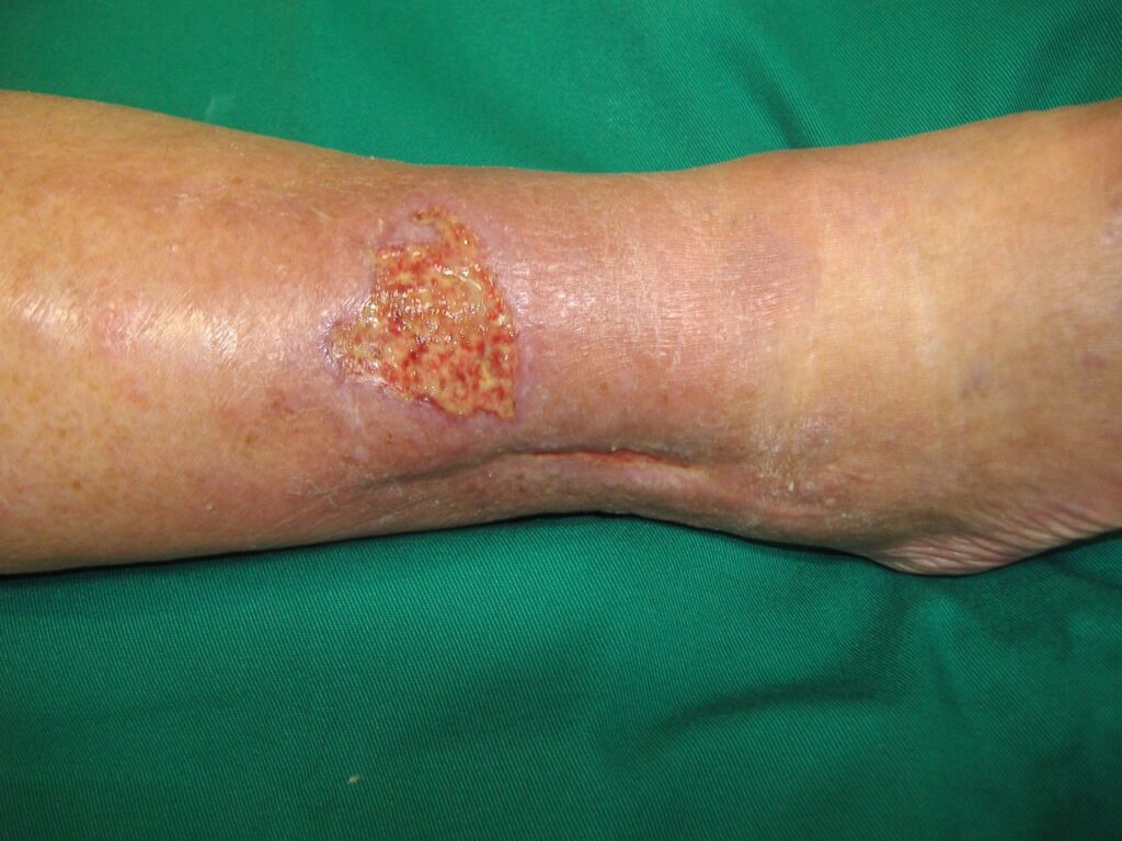 0 Ulceras desbridamiento enzimatico 1