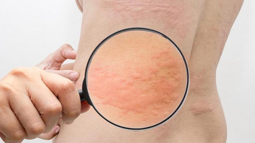 0 Urticaria rilzabrutinib