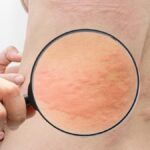 0 Urticaria rilzabrutinib