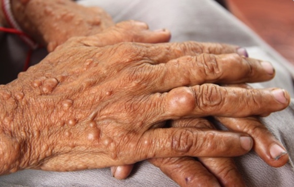 1 Dermatología genética