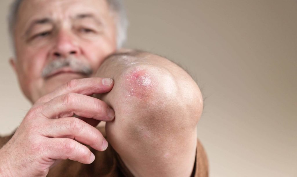 1 Fototerapia adultos mayores