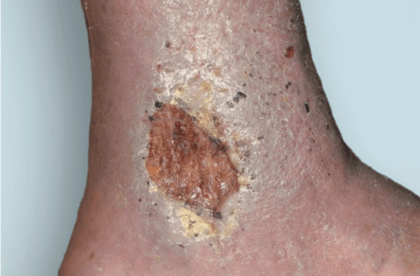 1 Ulceras desbridamiento enzimatico 2