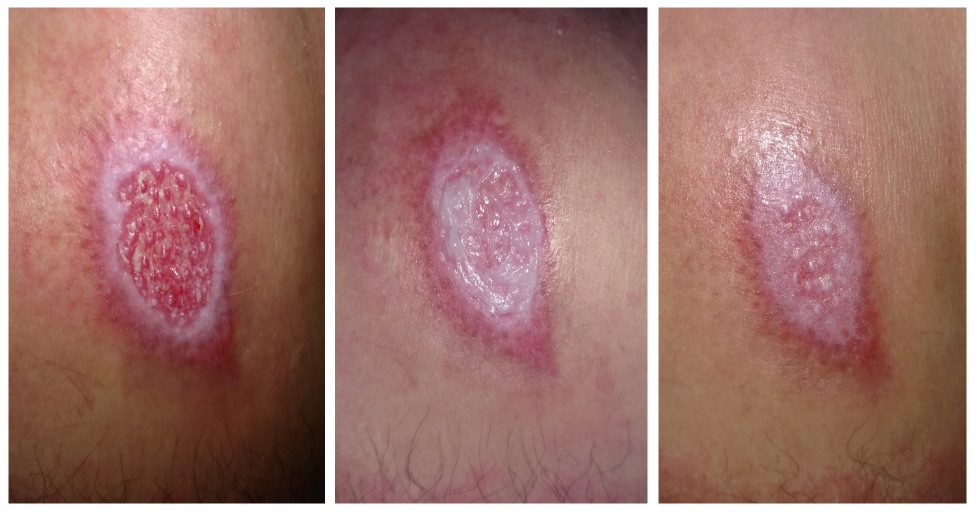 1 Ulceras desbridamiento enzimatico 1
