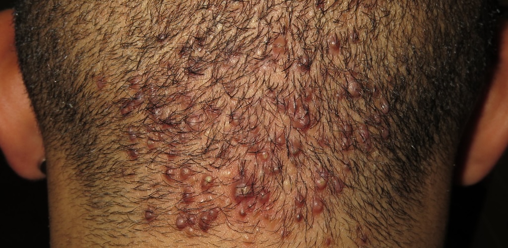 2 Ulceras desbridamiento enzimatico 1
