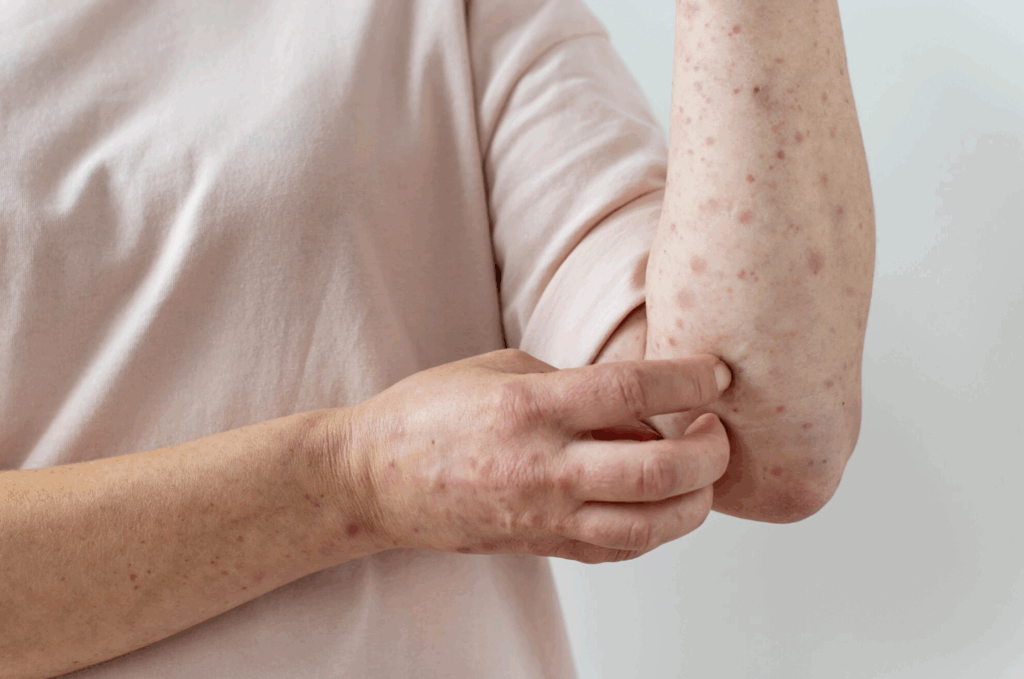 3 Fototerapia psoriasis
