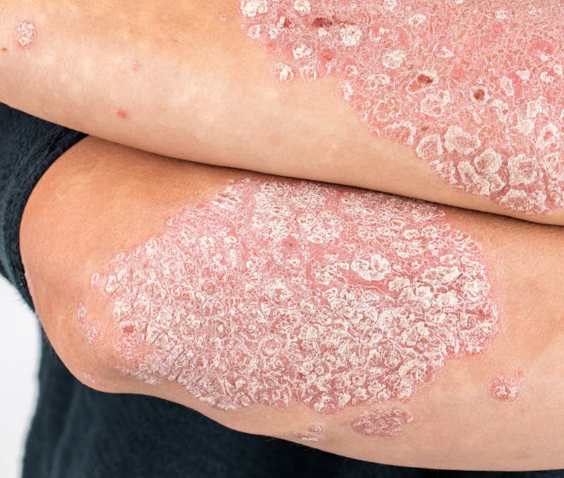 3-Psoriasis-fototerapia