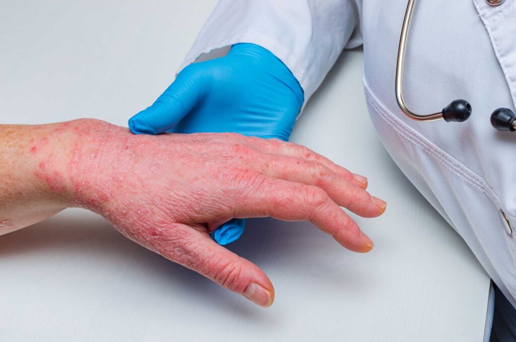3 Psoriasis fototerapia