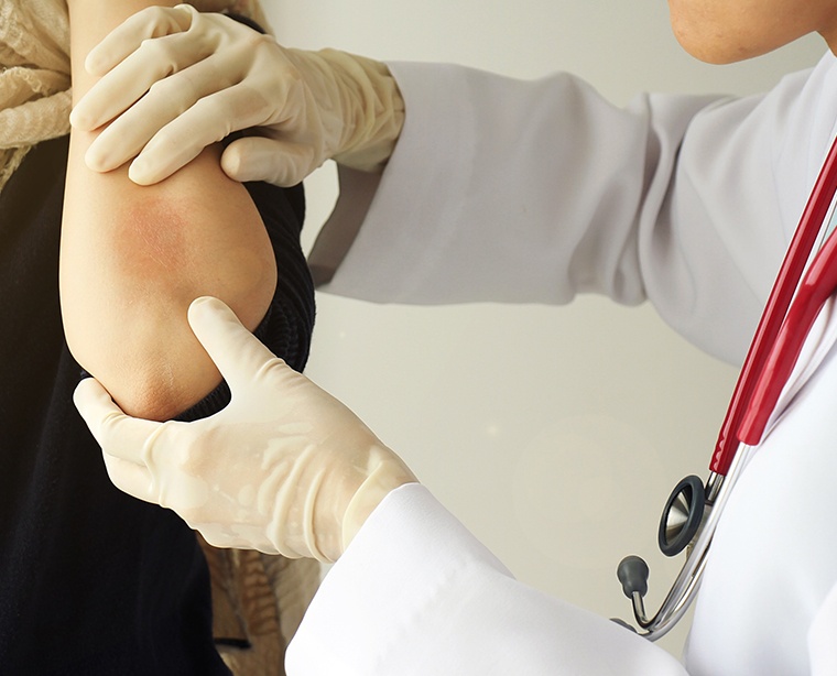 3 Urticaria rilzabrutinib