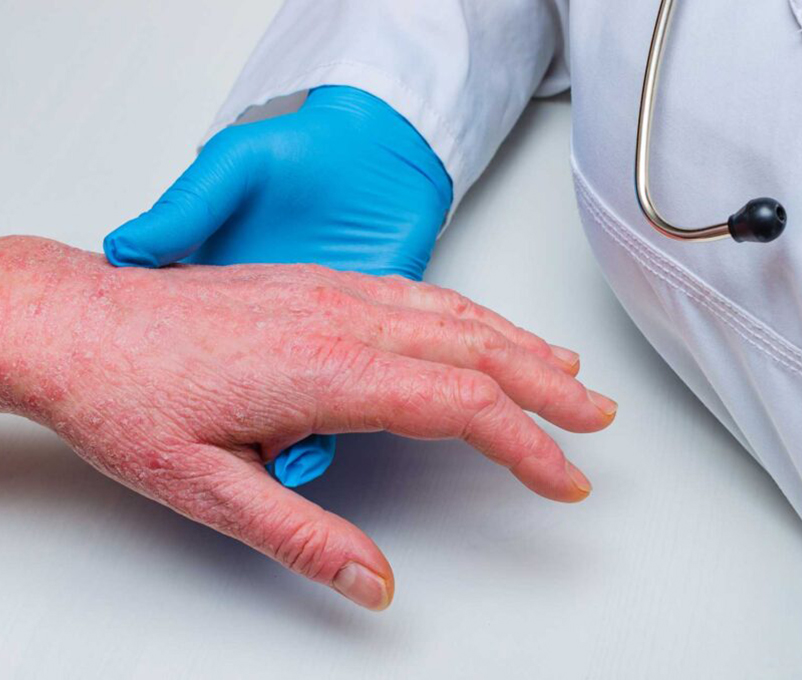 4-Psoriasis-fototerapia