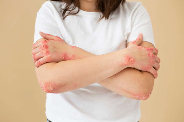 4 Psoriasis fototerapia