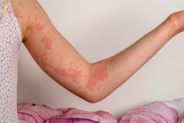 4 Urticaria rilzabrutinib