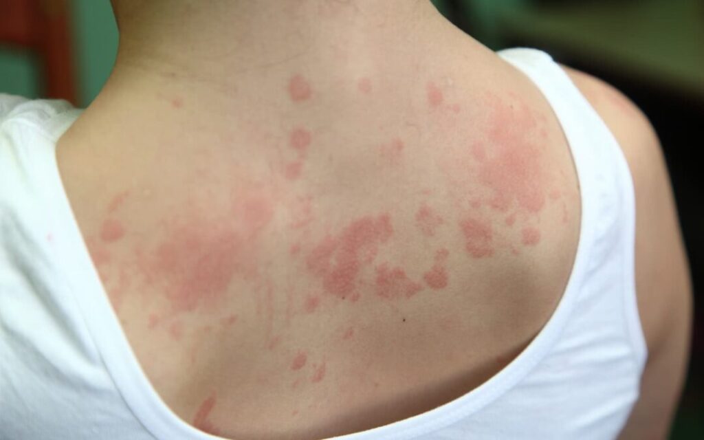 5 Urticaria rilzabrutinib