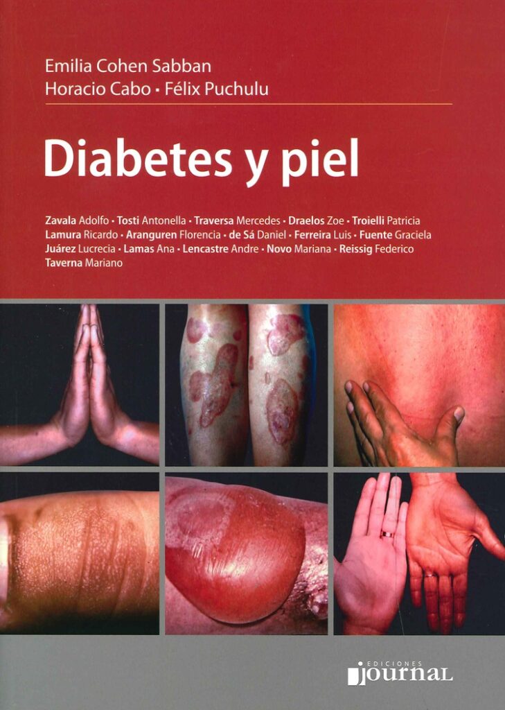 5-diabetes-piel-guia