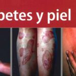 00-diabetes-piel-guia