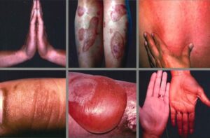 000-diabetes-piel-guia