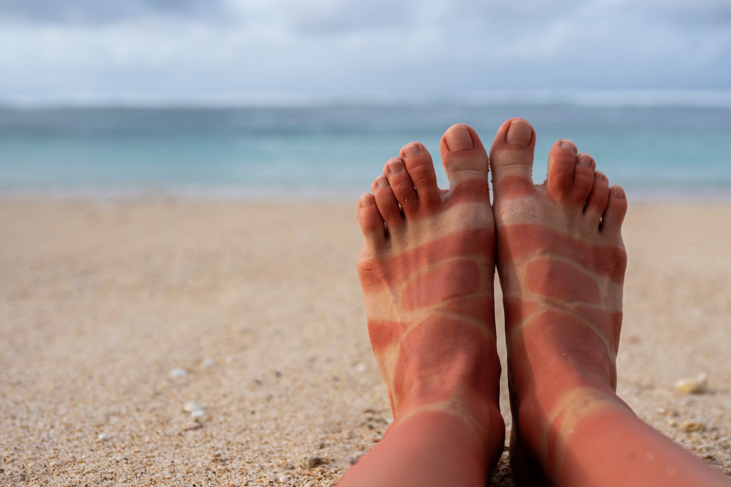 0 Cáncer piel cambio climático