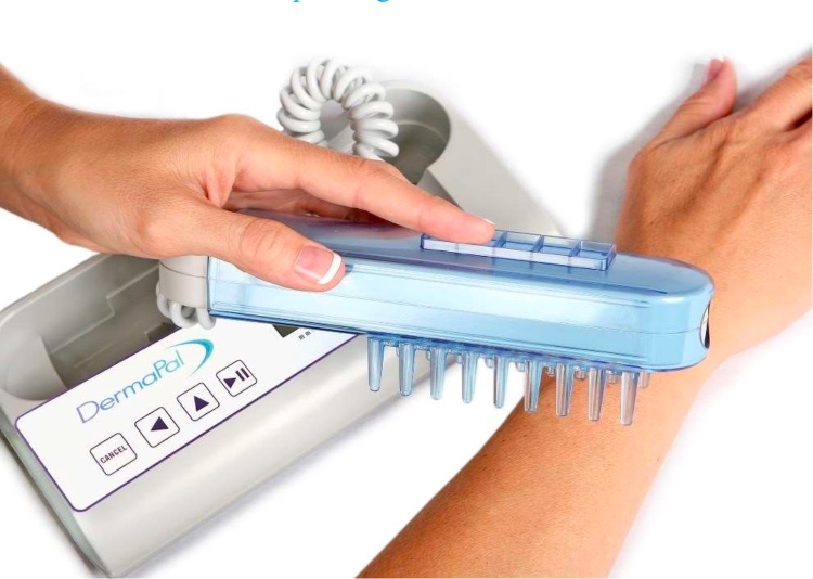 0 Fototerapia urticaria crónica espontánea