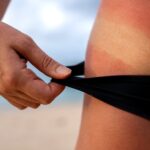 0 Sol enfermedades piel