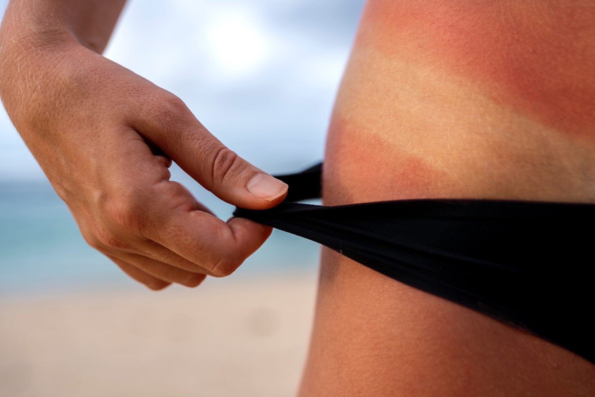 0 Sol enfermedades piel