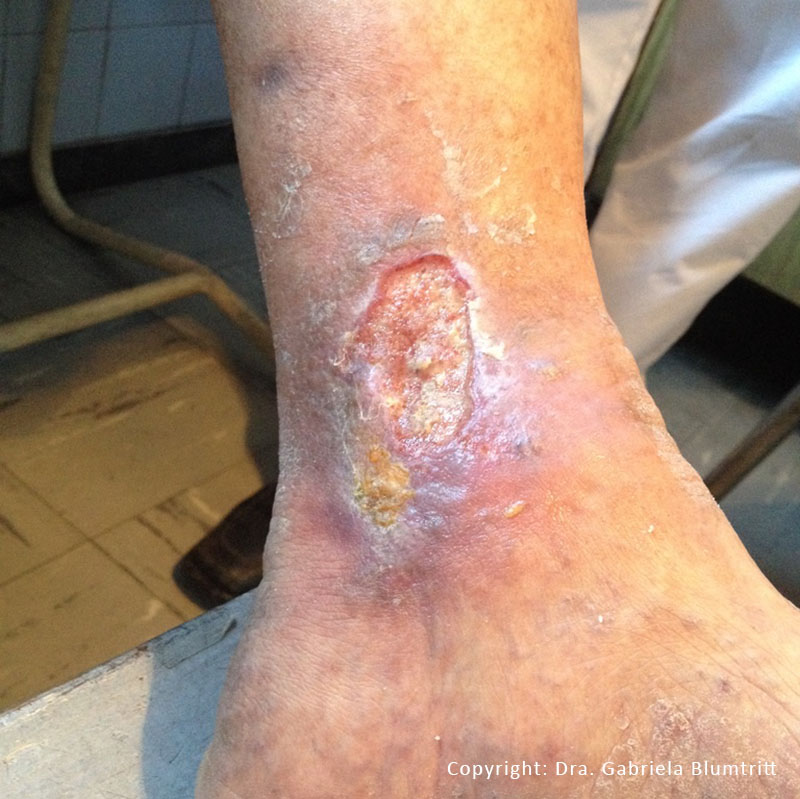 1 Desbridamiento enzimático úlceras vasculares 