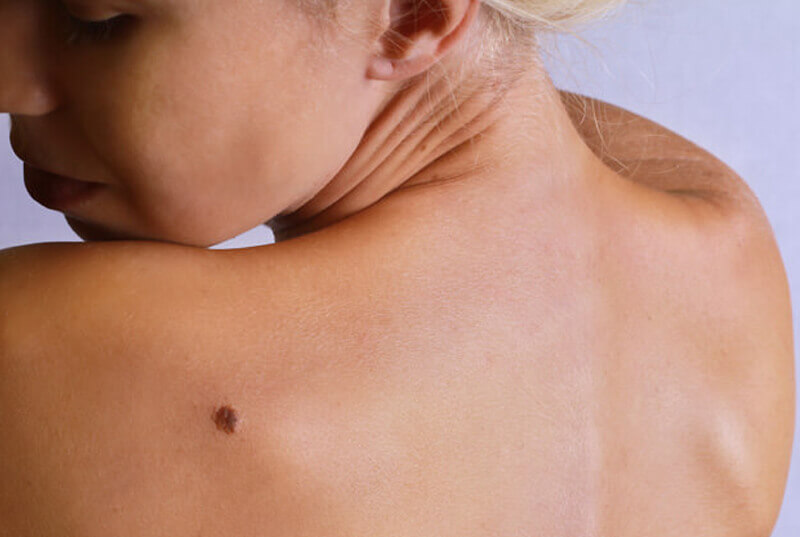 10 Melanoma rayos UV