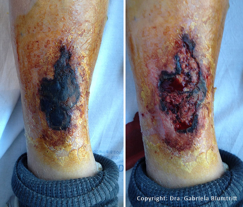 2 Desbridamiento enzimático úlceras vasculares 