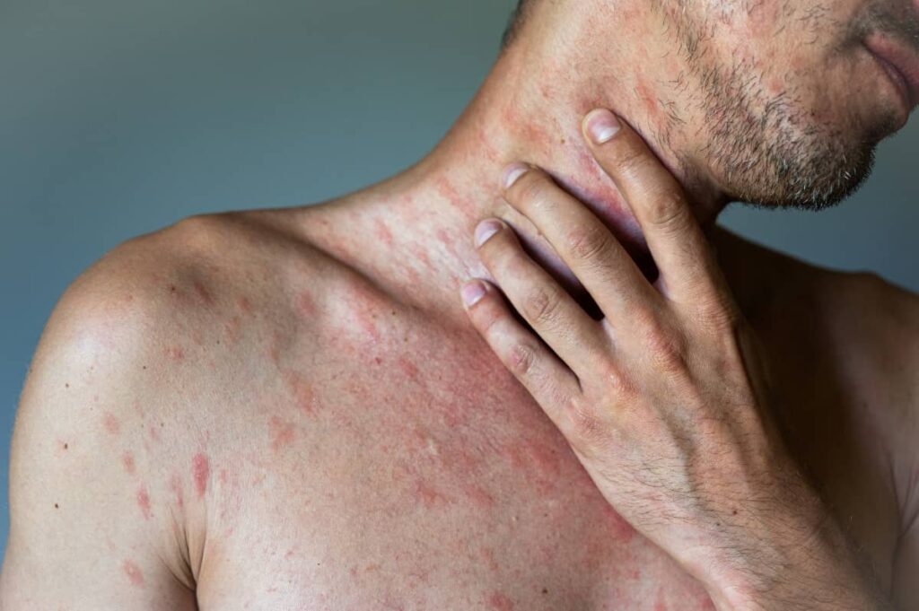 2 Fototerapia urticaria crónica espontánea