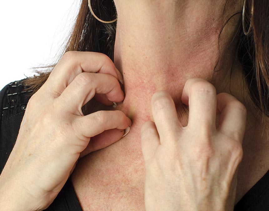 3 Fototerapia urticaria crónica espontánea