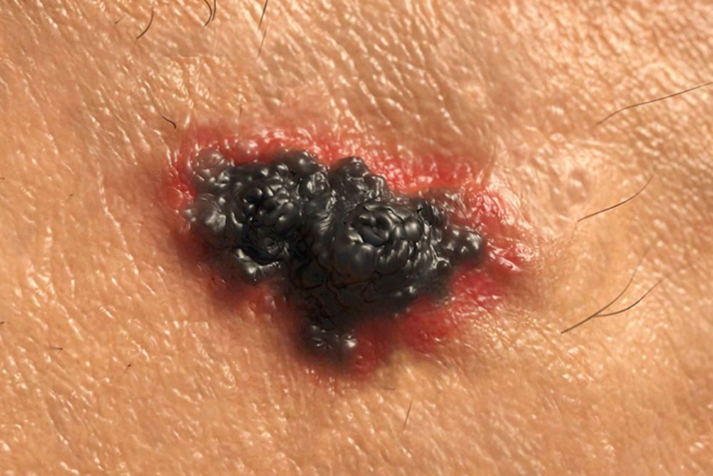 3 Melanoma rayos UV