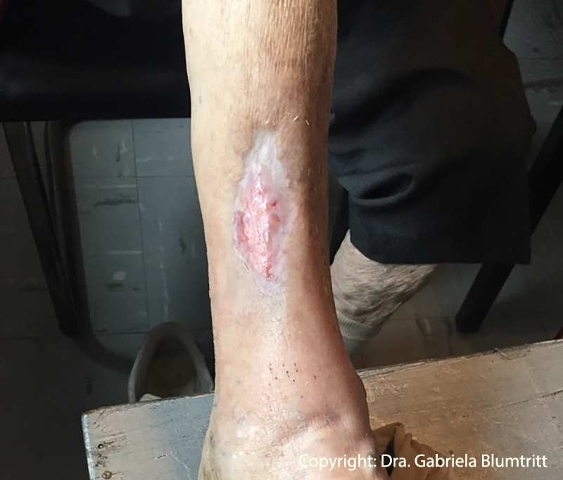 4 Desbridamiento enzimático úlceras vasculares 