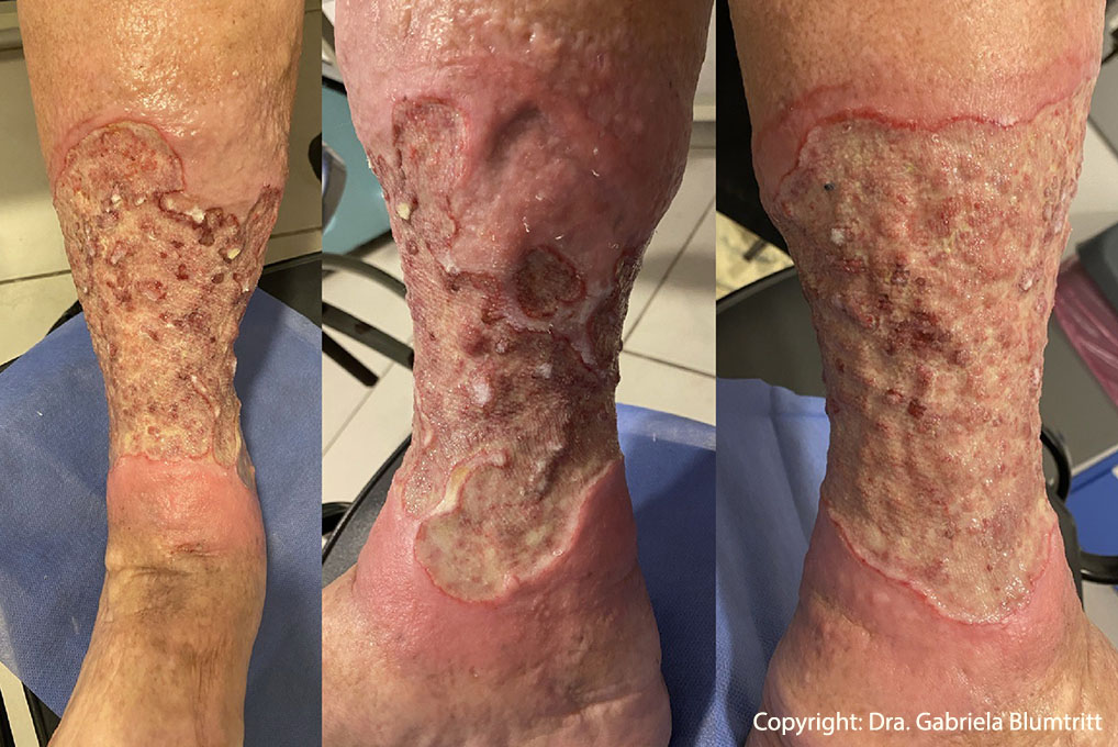 5 Desbridamiento enzimático úlceras vasculares 