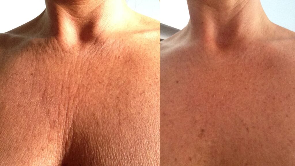 5 Sol enfermedades piel