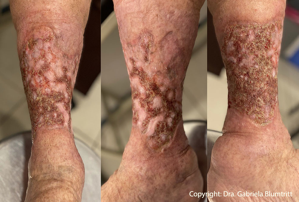 6 Desbridamiento enzimático úlceras vasculares 