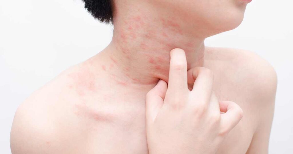 6 Fototerapia urticaria crónica espontánea