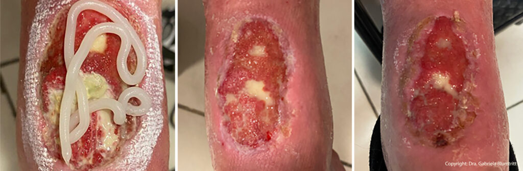 7 Desbridamiento enzimático úlceras vasculares