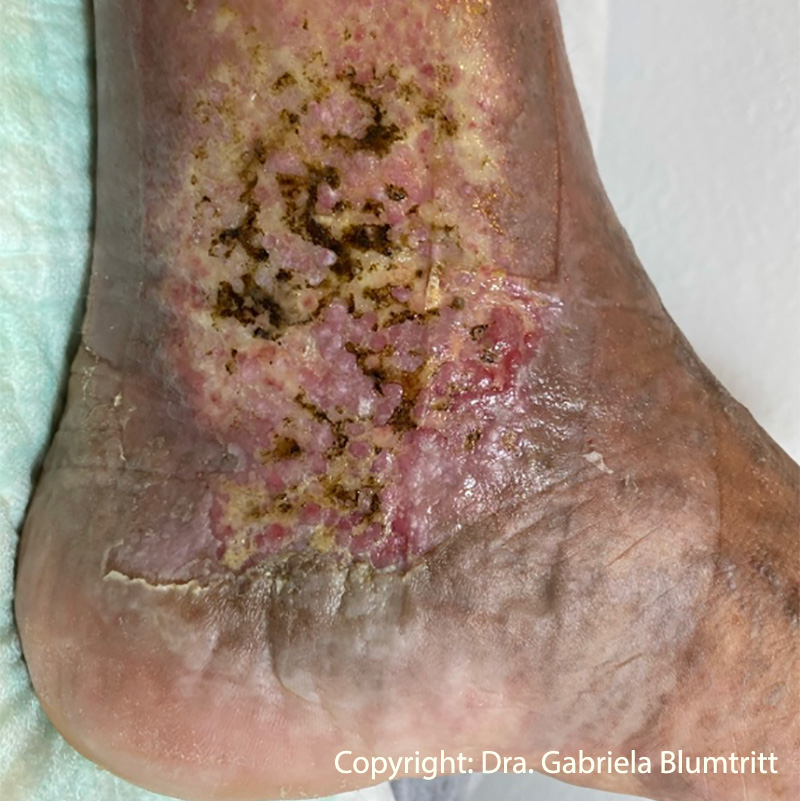 8 Desbridamiento enzimático úlceras vasculares