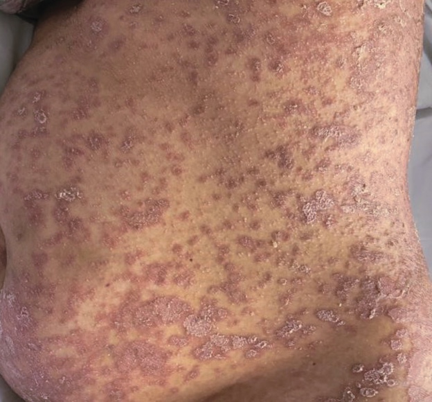 8 Dermatología Argentina 3 2025
